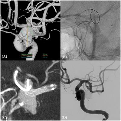 Single Neuroform Atlas stent: a reliable approach for treating complex wide-neck bifurcated aneurysms
